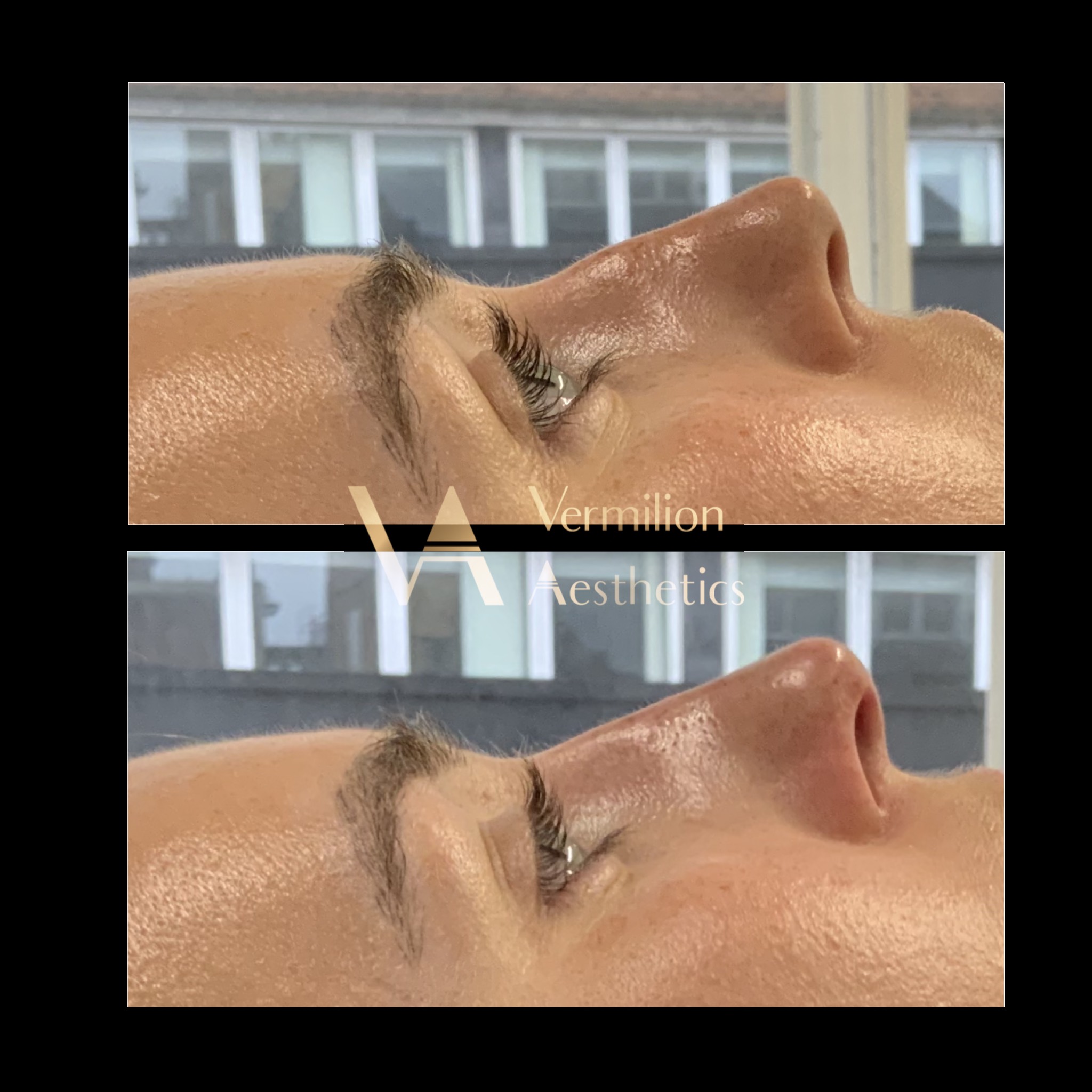 non surgical rhinoplasty