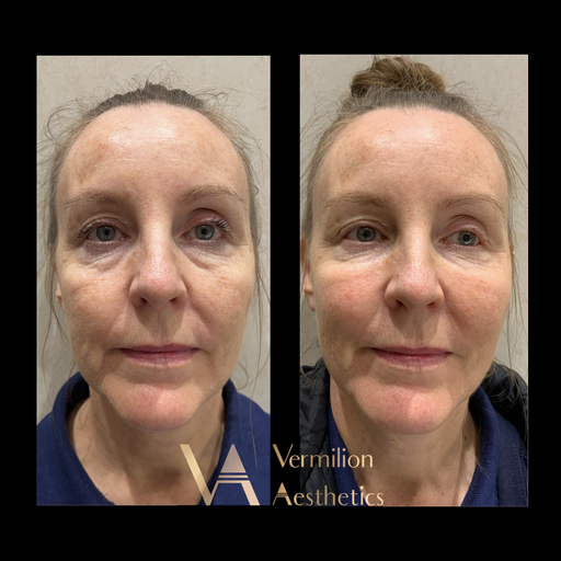 Anti Wrinkle Northwood Hills  Get a Natural and Smooth Skin